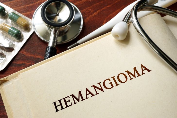 What Are Hemangiomas?