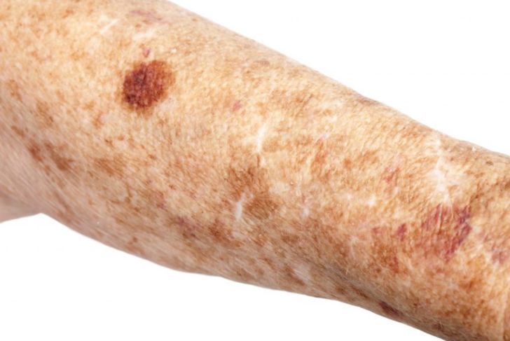 What are Liver Spots?