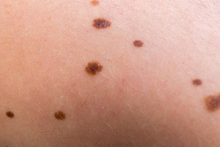 What are Liver Spots?