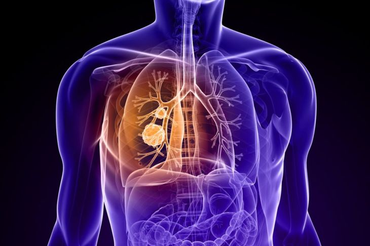 What are Lung Nodules?