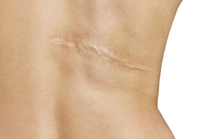What Are Skin Grafts and How Are They Done?