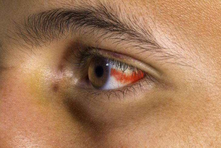 What are Subconjunctival Hemorrhages?