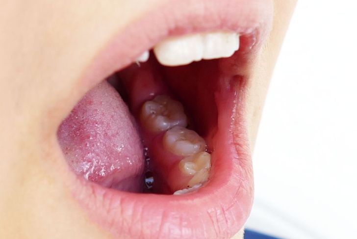 What are Tonsil Stones?