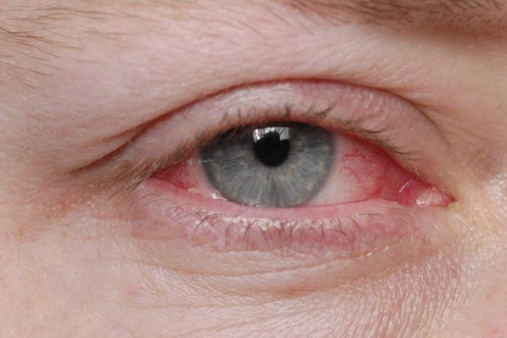 What Causes a Scratched Cornea?