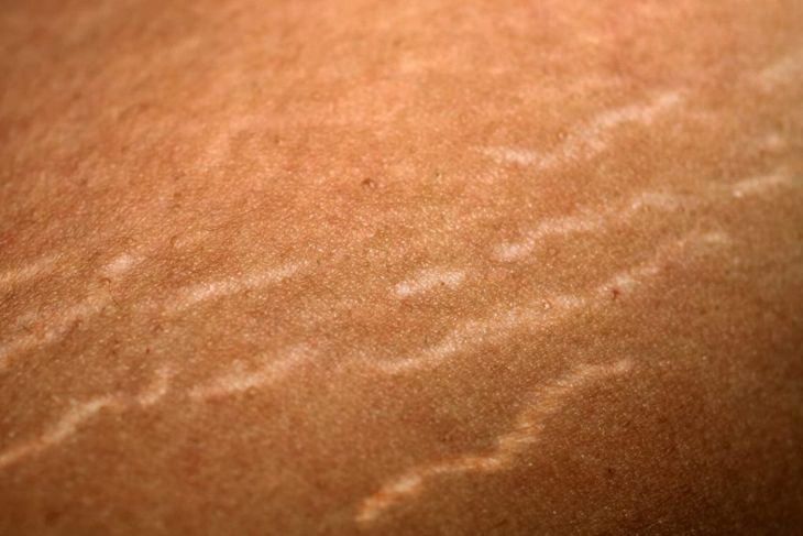 What Causes Stretch Marks?