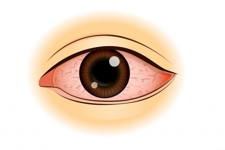 What Is a Corneal Ulcer?