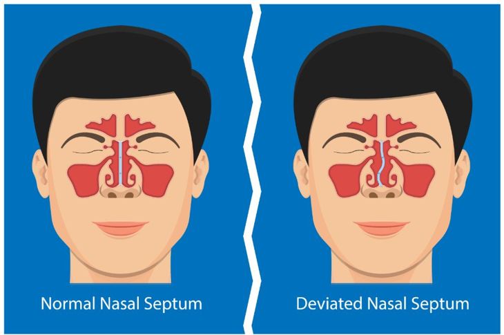 What is a Deviated Septum?