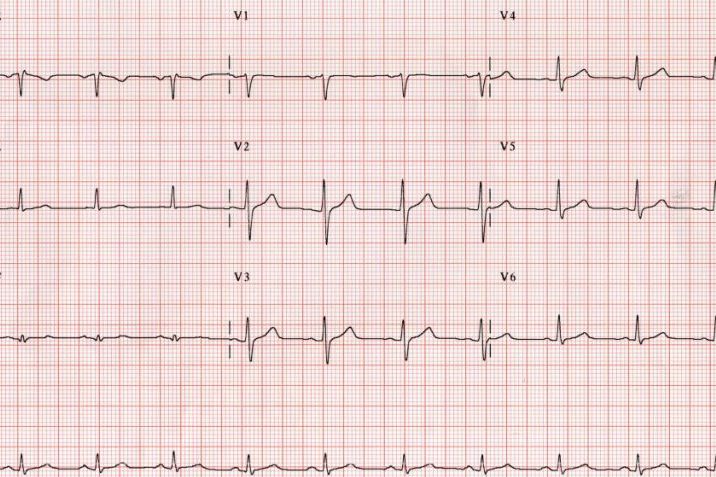 What is an Electrocardiogram?