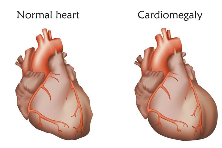 What is an Enlarged Heart?