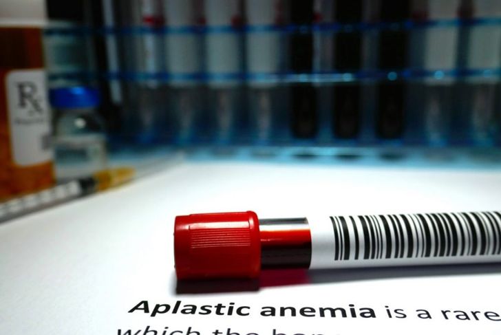 What is Aplastic Anemia?