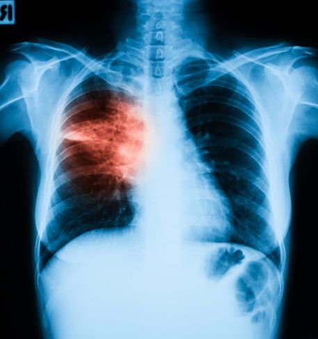 What is Aspiration Pneumonia?
