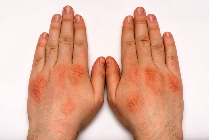 What is Cellulitis?