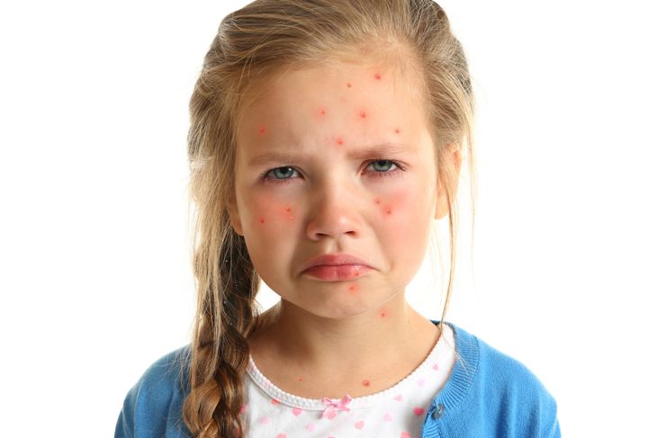 What is Chickenpox? Symptoms and Treatment