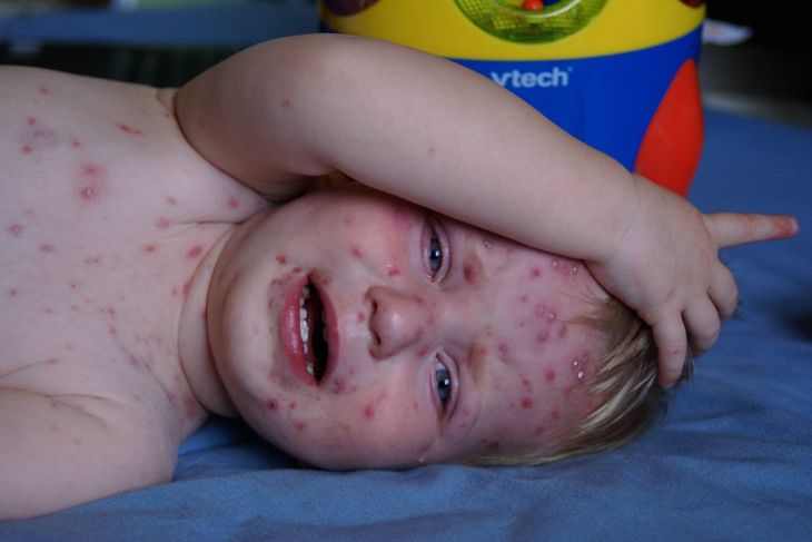 What is Chickenpox? Symptoms and Treatment
