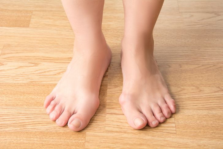 What is Clubfoot? Treatments and Symptoms