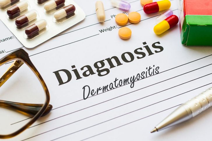 What Is Dermatomyositis?