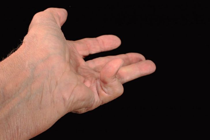 What is Dupuytren's Contracture and How is it Treated?