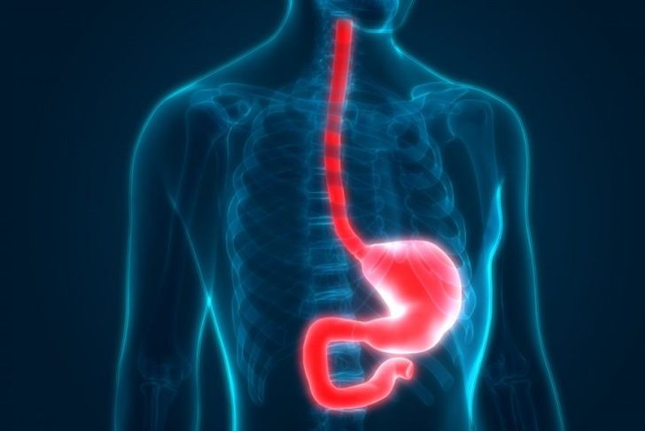 What is Esophageal Achalasia?