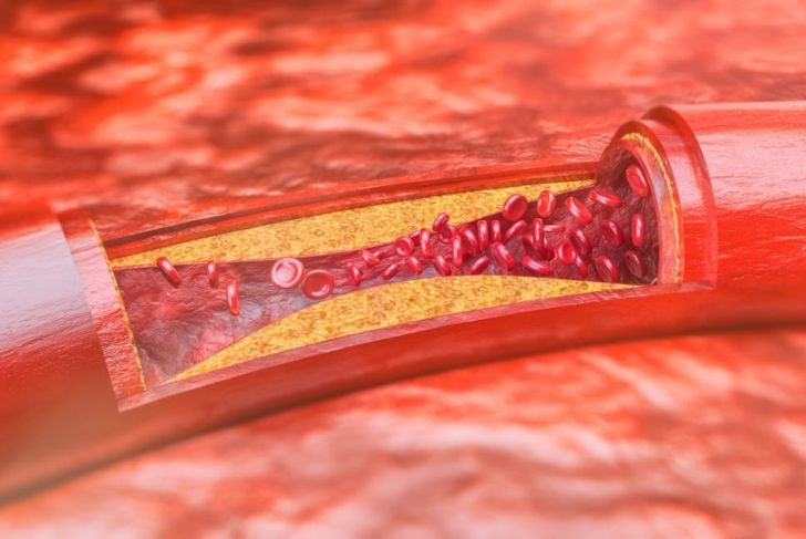 What Is Hyperlipidemia?