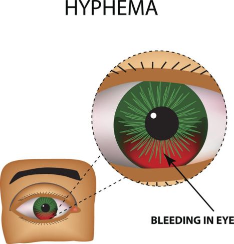 What is Hyphema?
