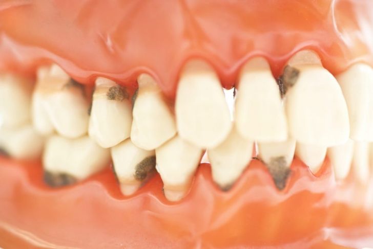 What is Malocclusion?