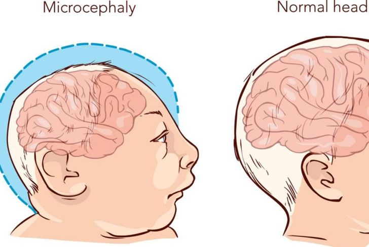 What is Microcephaly?