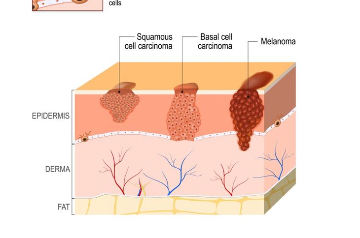 What is Squamous Cell Carcinoma?