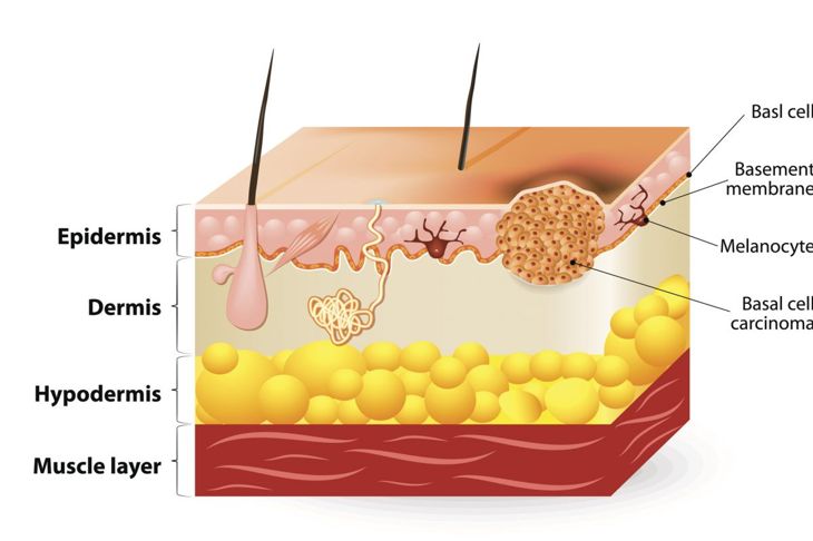 What is Squamous Cell Carcinoma?