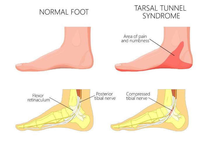 What is Tarsal Tunnel Syndrome? - Health & Detox & Vitamins