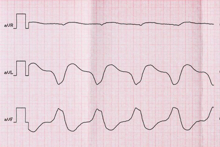 What is Ventricular Fibrillation