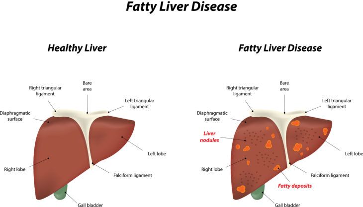 What to Eat to Reverse Fatty Liver Disease