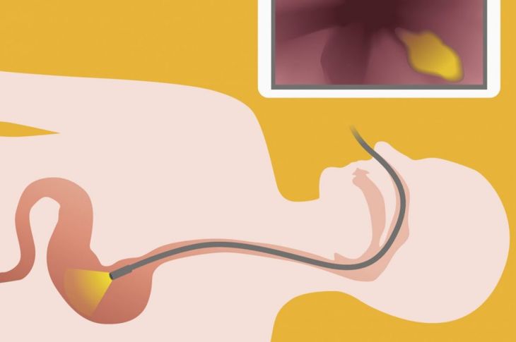 What You Need To Know About Nasoendoscopy