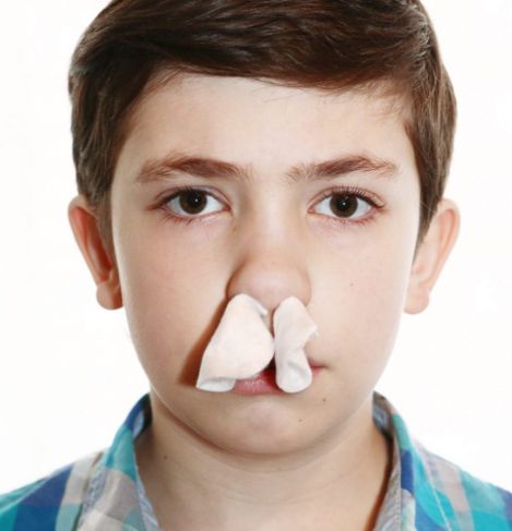 What You Need to Know about Nosebleeds (Epistaxis)