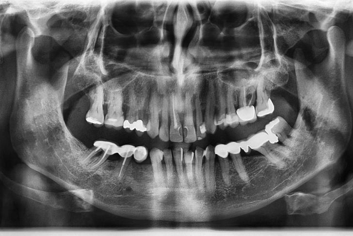 What You Need to Know About Root Canals