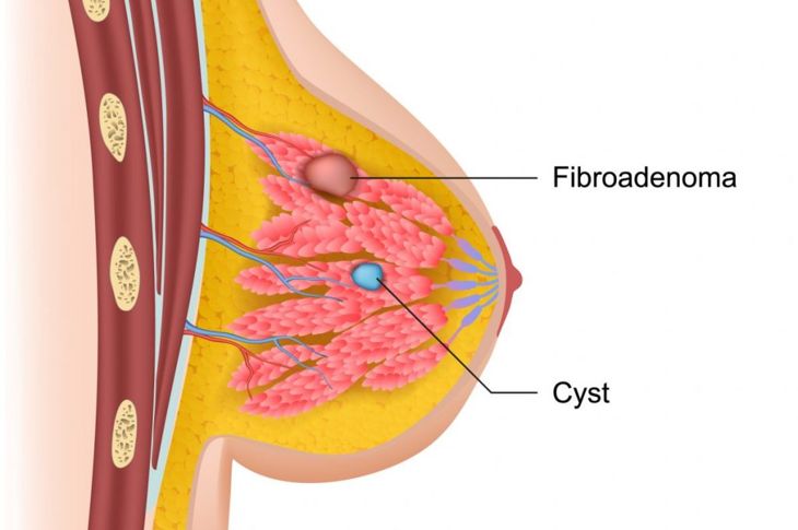 What You Should Know About Non-Cancerous Fibroadenoma