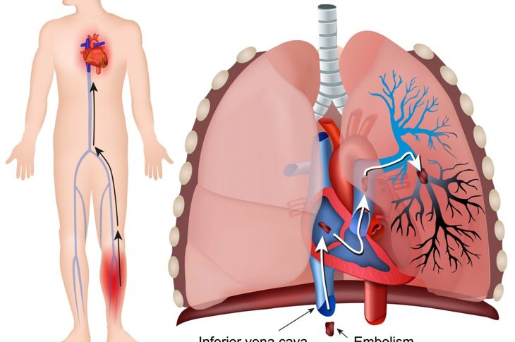 When Can a Blood Clot Cause a Pulmonary Embolism?