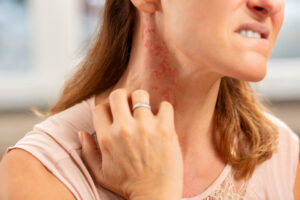 What are the Symptoms of Allergy and the Treatment for Allergy?