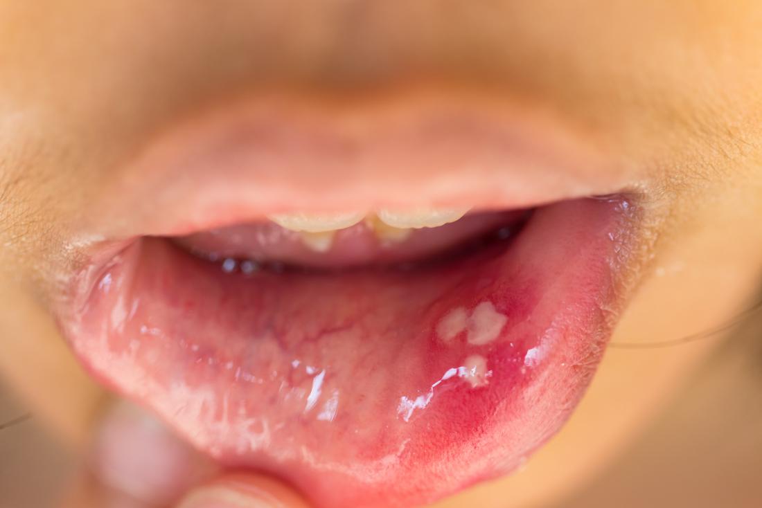 What are the Symptoms of Humaan Papillomavirus and the Treatment for Humaan Papillomavirus?