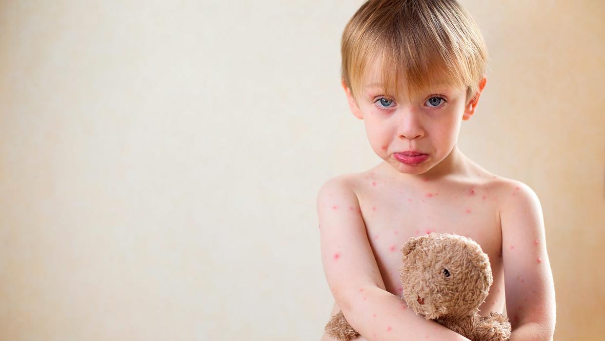 What are the Symptoms of Chicken Pox and the Treatment for Chicken Pox?