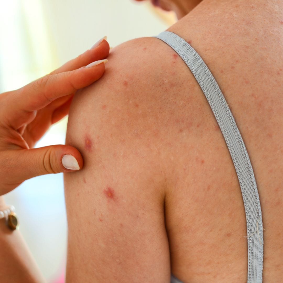 What are the Symptoms of Skin Cancer and the Treatment for Skin Cancer?
