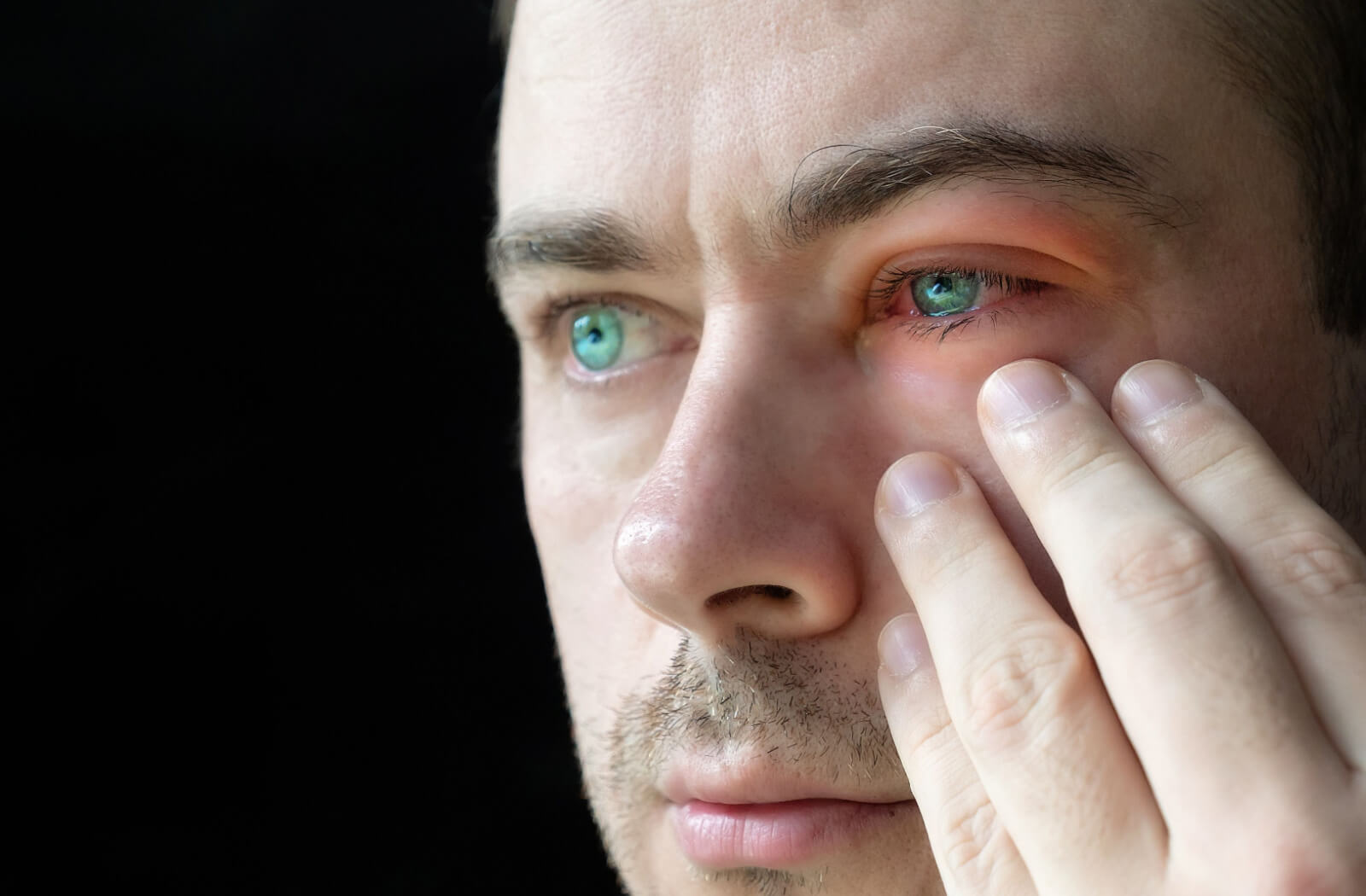 What are the Symptoms of Pink Eye and the Treatment for Pink Eye?