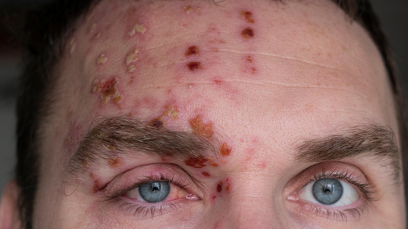 What are the Symptoms of Chicken Pox and the Treatment for Chicken Pox?