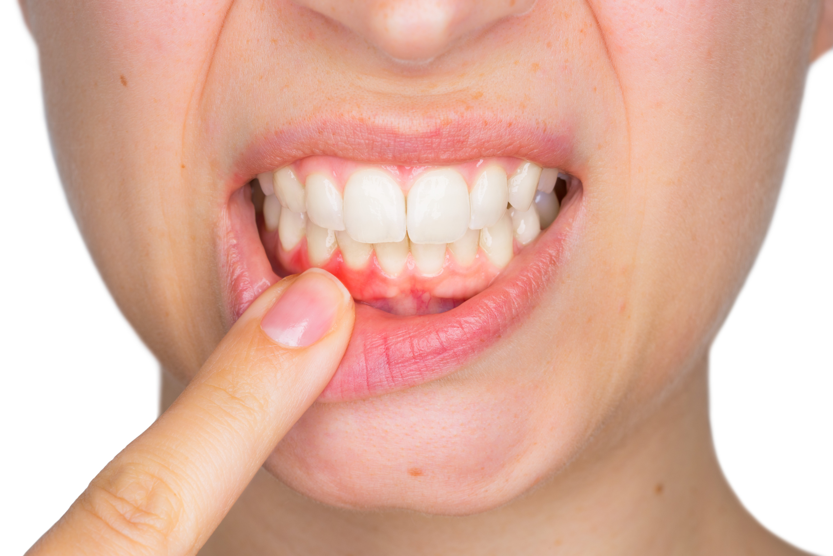 What are the Symptoms of Sore Gums and the Treatment for Sore Gums?