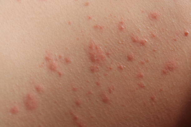 What are the Symptoms of Roseola Rash and the Treatment for Roseola Rash?