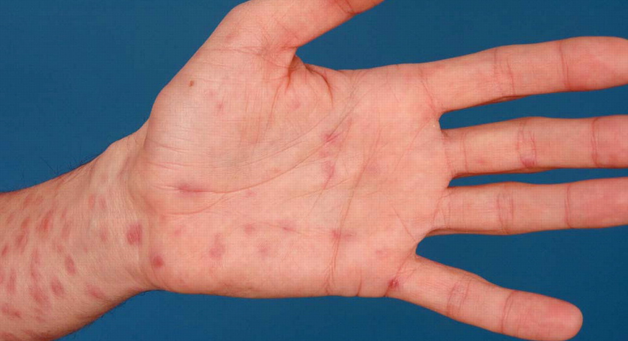 What are the Symptoms of Syphilis Rash and the Treatment for Syphilis Rash?