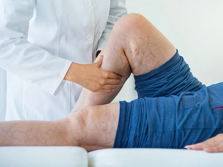 What are the Symptoms of DVT and the Treatment for DVT?