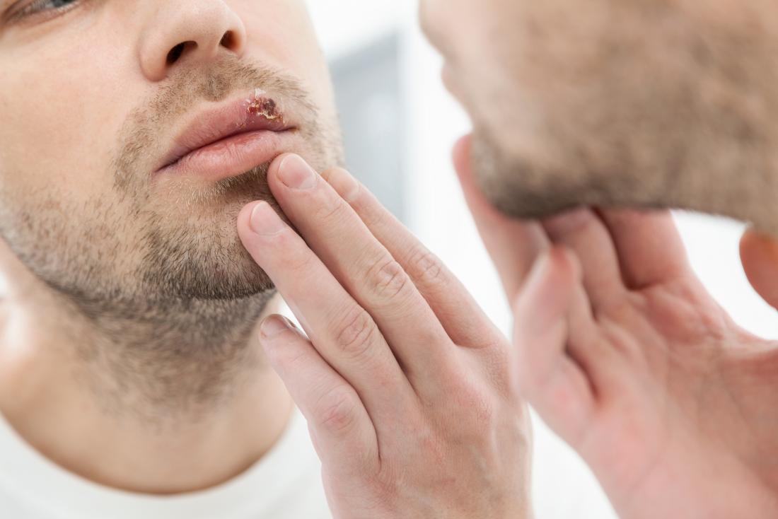 What are the Symptoms of Herpes in Men and the Treatment for Herpes in Men?