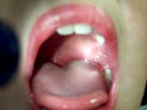 What are the Symptoms of Mucus Stuck in Throat and the Treatment for Mucus Stuck in Throat?
