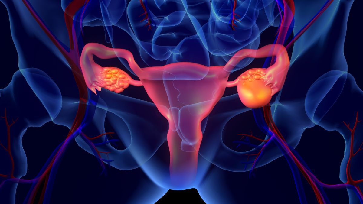 What are the Signs and Symptoms of Ovarian Cancer and the Treatment for Ovarian Cancer?