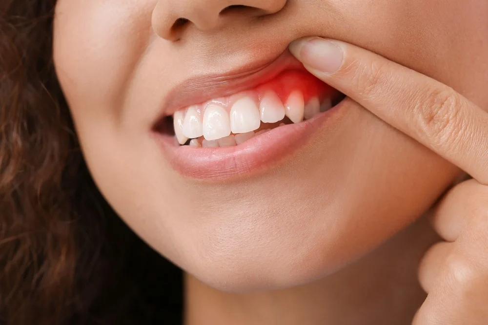 What are the Symptoms of Gingivitis and the Treatment for Gingivitis?